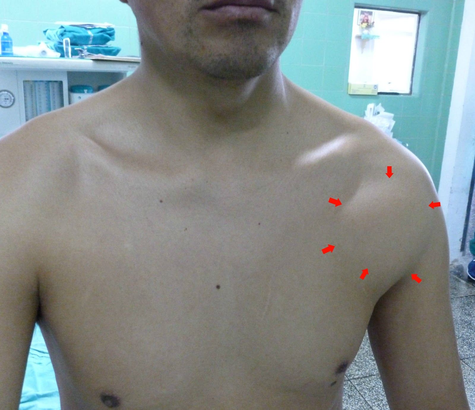 bultos en los hombros